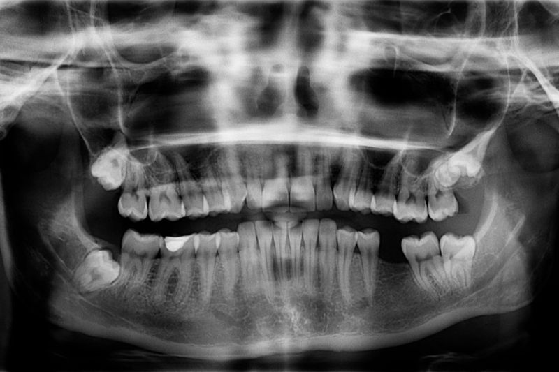 removing-problematic-wisdom-teeth-leeds