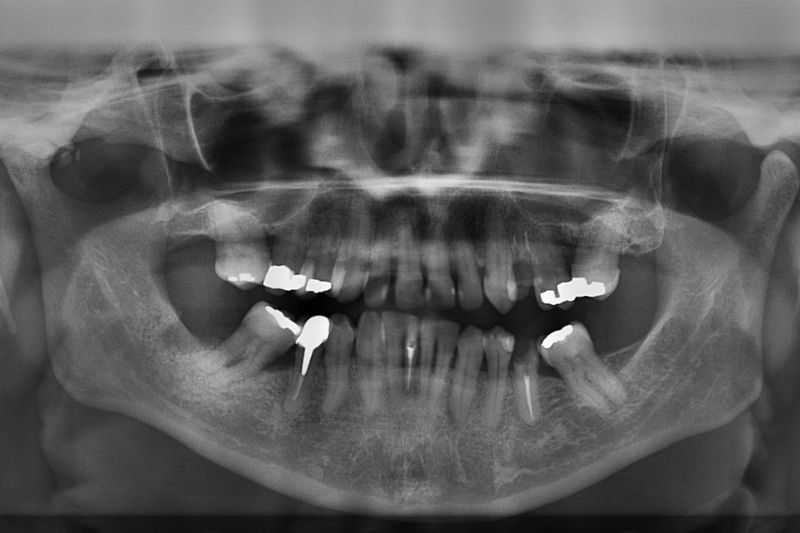 complex root canal cases leeds